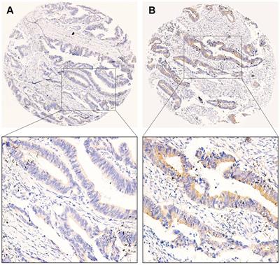 Clinical and Prognostic Relevance of B7-H3 and Indicators of Glucose Metabolism in Colorectal Cancer